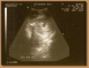 Kewpie Doll's ultrasound taken on January 30th, 2008.